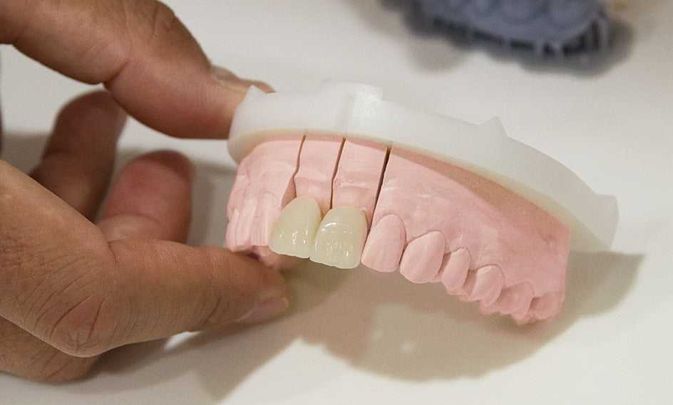 Carillas dentales