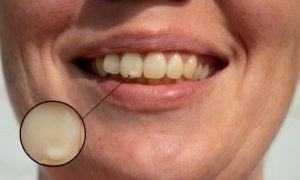 sonrisa con manchas en el esmalte