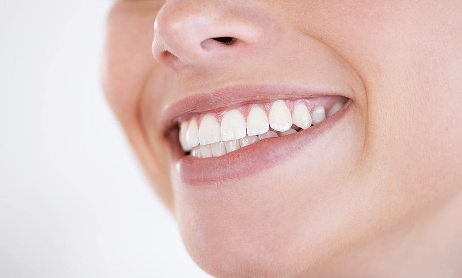 Ventajas de las carillas dentales