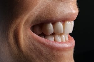 Ortodoncia o carillas: ¿Qué elegir para alinear tus dientes?