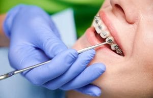 Ortodoncia o carillas: ¿Qué elegir para alinear tus dientes?