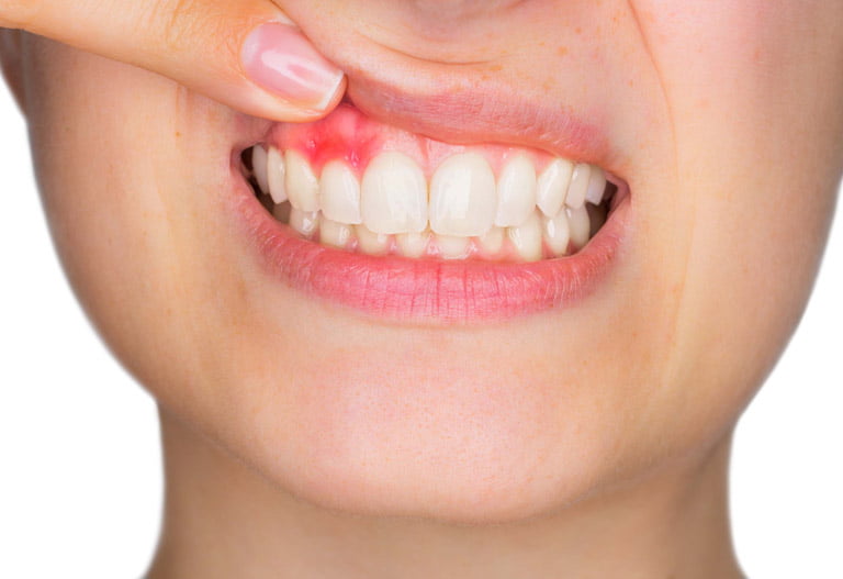 Diferencia entre gingivitis y periodontitis - Suárez Rivaya, tu Clínica Dental en Avilés