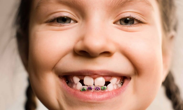 ¿A qué edad se recomienda poner brackets a los niños? Suárez Rivaya, tu dentista en Avilés.