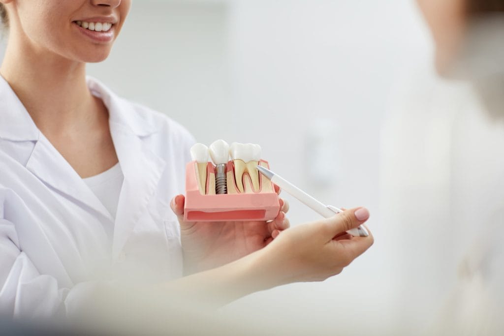 Partes de un implante dental: todo lo que debes saber