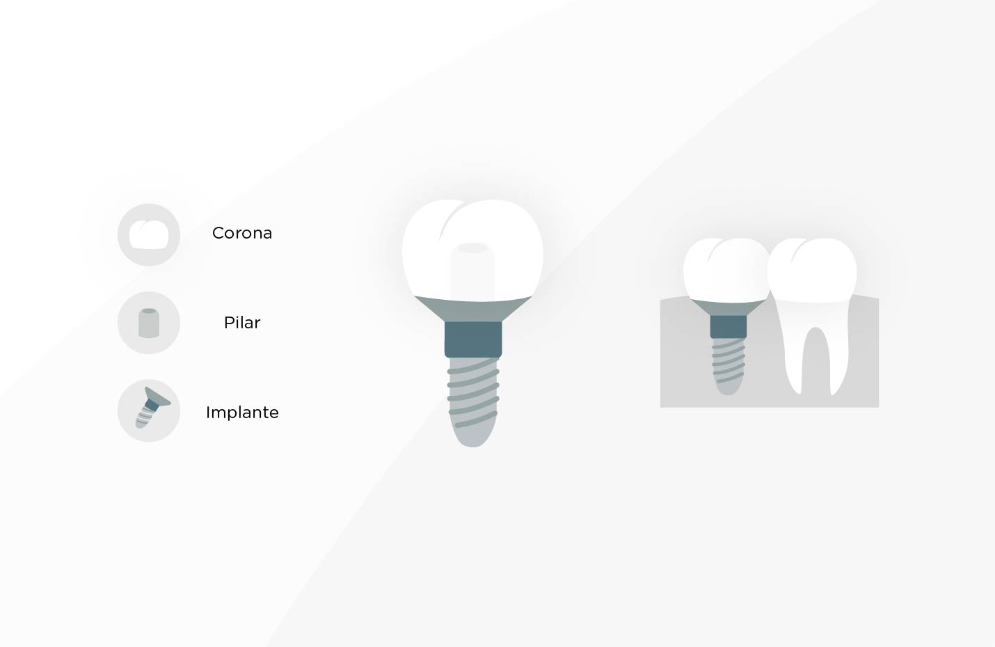 partes de un implante dental