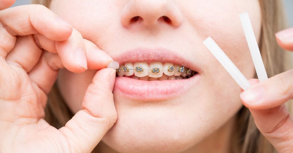 Una chica joven con brackets aplicándose su cera para los brackets.