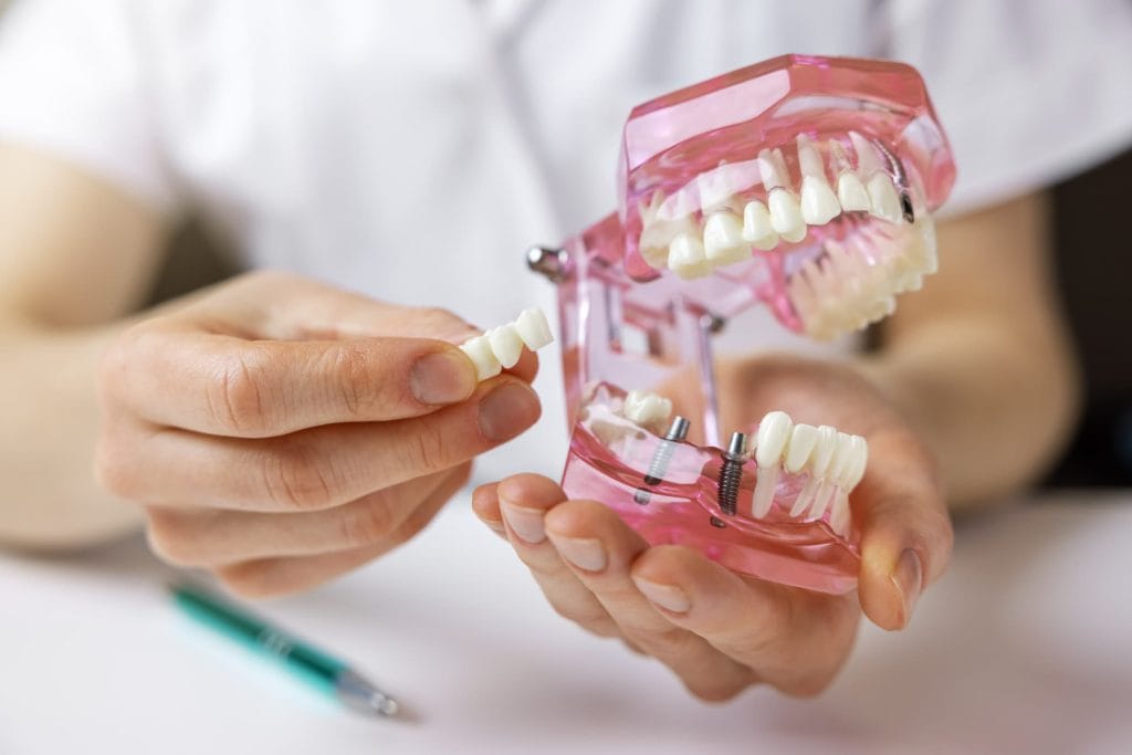 Cómo elegir el implante dental adecuado