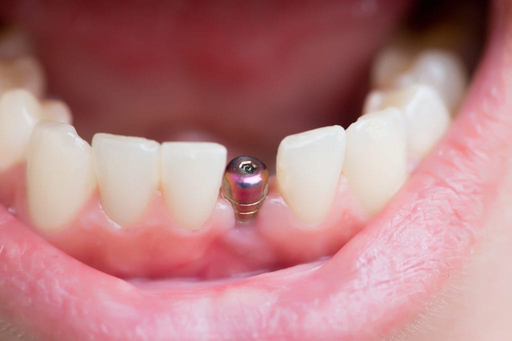 Postoperatorio de los implantes dentales: ¿cuándo cicatrizan?