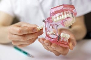 ¿Cuánto tiempo tarda en cicatrizar el implante dental?