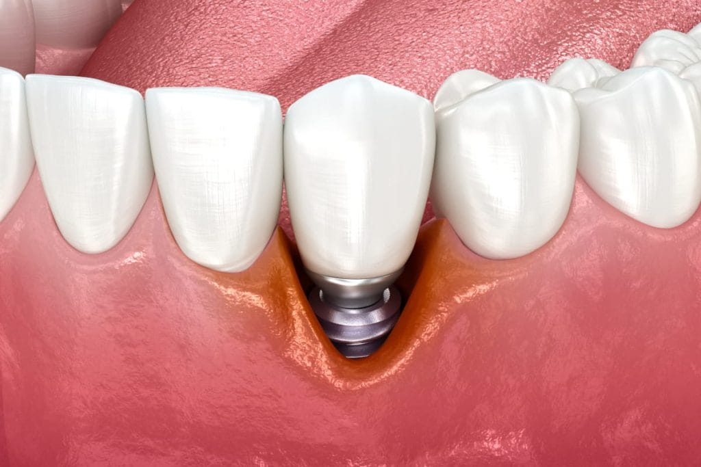 ¿Por qué ocurren las infecciones en implantes dentales?