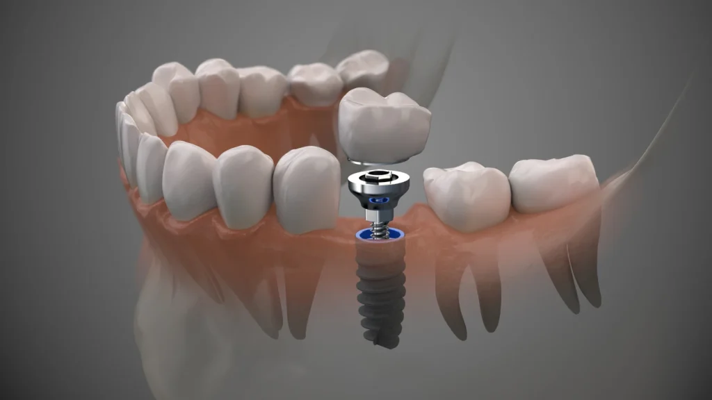 cononas-sobre-implantes
