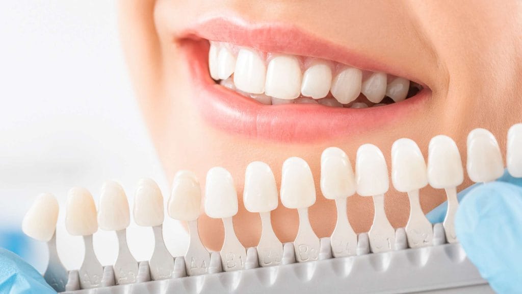 ¿Cuánto dura un blanqueamiento dental en clínica?