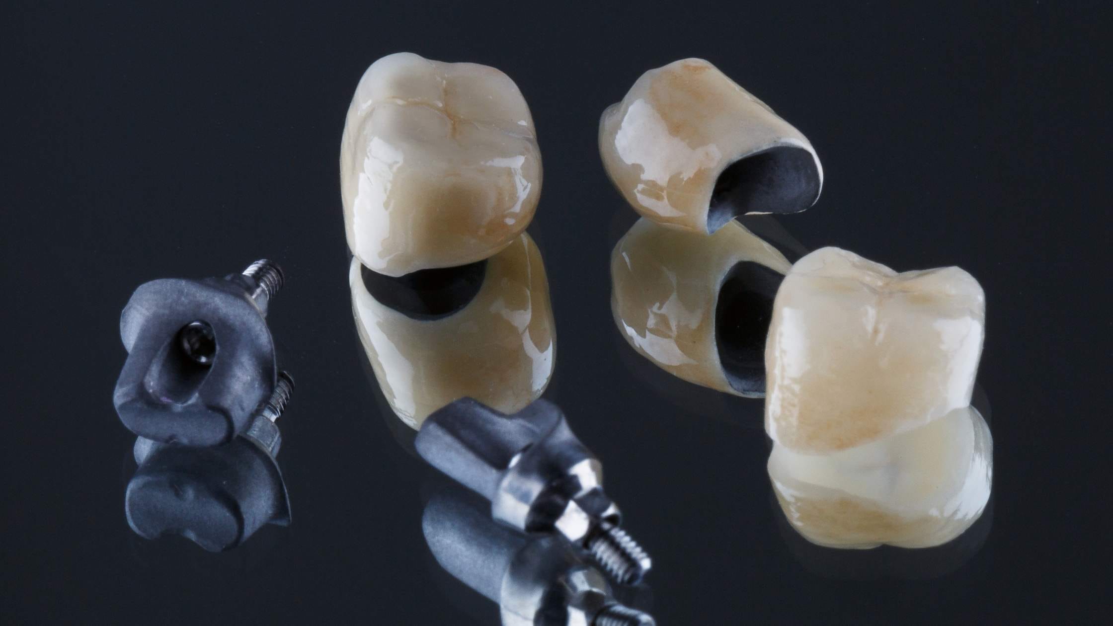 Coronas dentales en las muelas