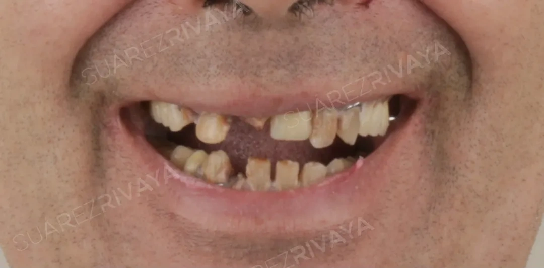 Antes