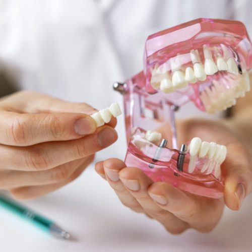 ¿Cuánto tiempo tarda en cicatrizar el implante dental?
